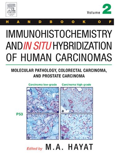 Book Handbook of Immunohistochemistry and in Situ Hybridization of Human Carcinomas: Molecular Pathology, Colorectal Carcinoma, and Prostate Carcinoma free