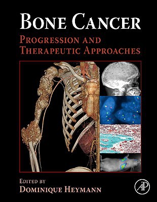 Book Bone Cancer: Progression and Therapeutic Approaches free