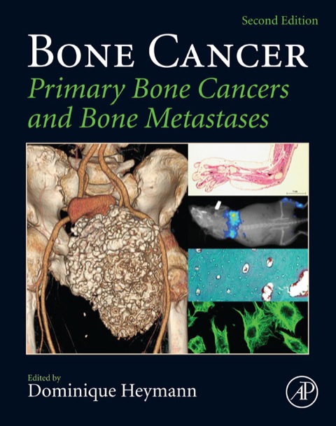 Book Bone Cancer: Primary Bone Cancers and Bone Metastases free