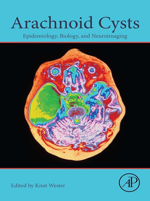 Book Arachnoid Cysts: Epidemiology, Biology, and Neuroimaging free