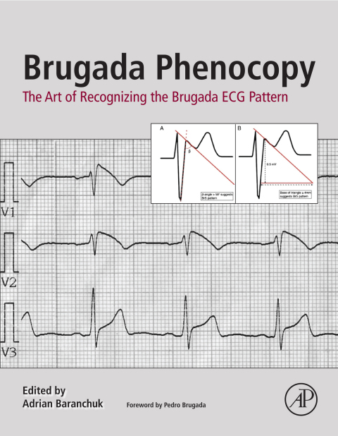 Book Brugada Phenocopy: The Art of Recognizing the Brugada ECG Pattern free