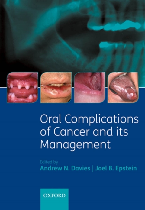 Book Oral Complications of Cancer and its Management free