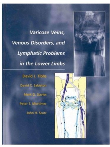 Book Varicose Veins, Venous Disorders, and Lymphatic Problems in the Lower Limbs free