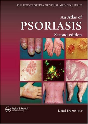 Book Atlas of Psoriasis (Encyclopedia of Visual Medicine Series Book 77) free
